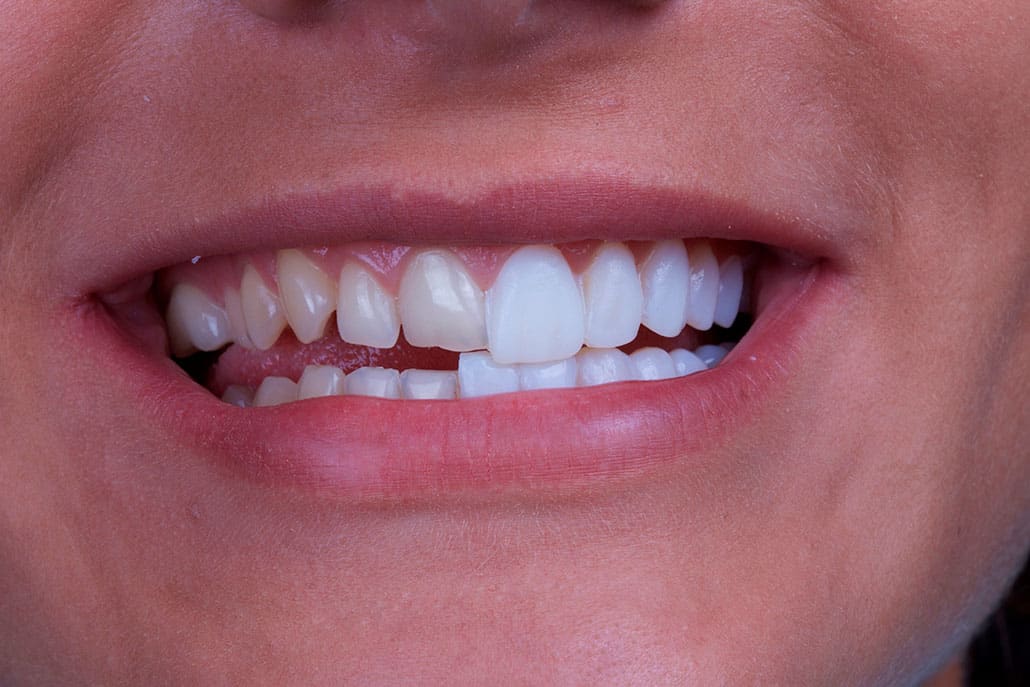 O que são facetas de porcelana?