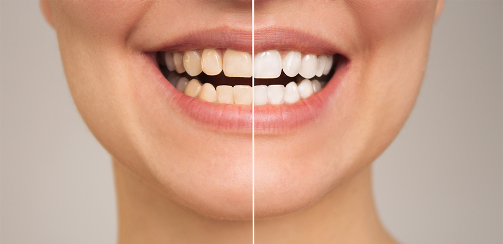 dr-guilherme-rudge-ramos-sp-clareamento-dental-facetas